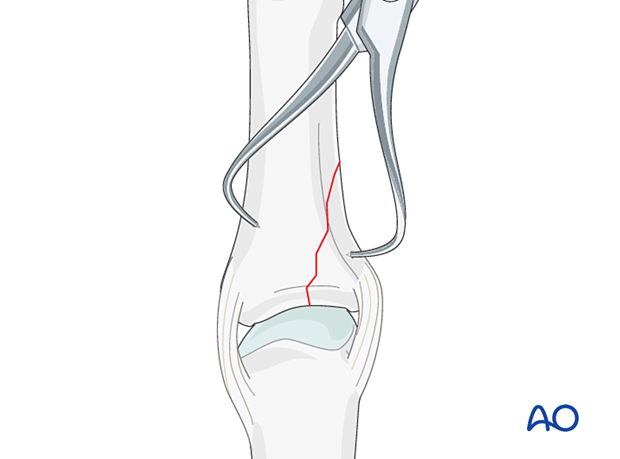 Direct reduction using small, pointed forceps of a vertical shearing fracture of the metacarpophalangeal joint - proximal phalanx – hand.