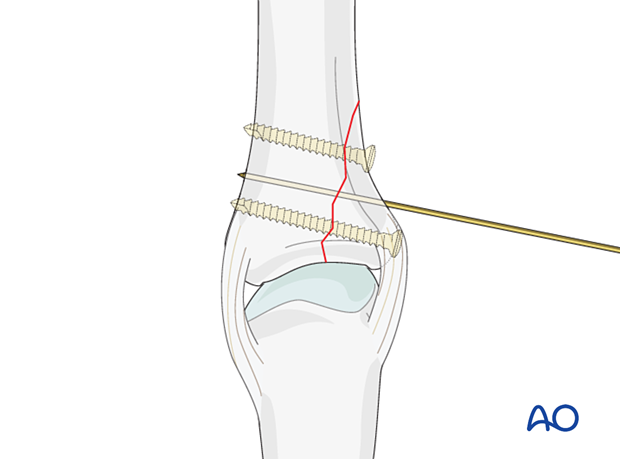 Preliminary K-wire fixation of a vertical shearing fracture of the metacarpophalangeal joint - proximal phalanx – hand.