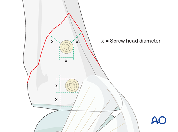 Peripheral screw insertion with two screws with minimal distance to the fracture line equal to the diameter of the screw head for a vertical shearing fracture of the metacarpophalangeal joint - proximal phalanx – hand.