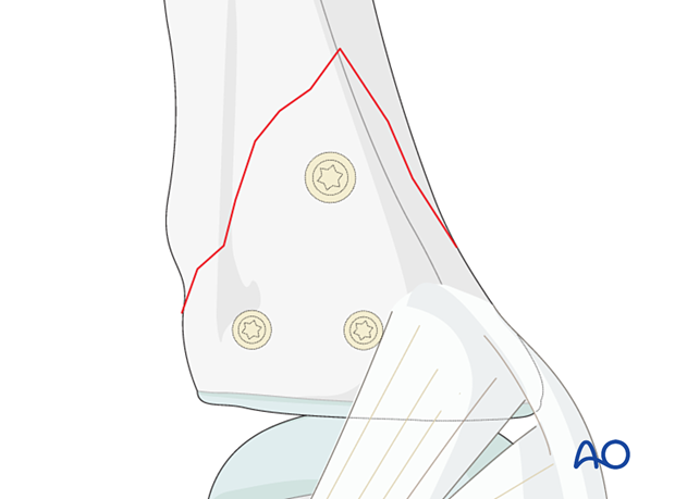 Peripheral screw insertion with three screws for a vertical shearing fracture of the metacarpophalangeal joint - proximal phalanx – hand.