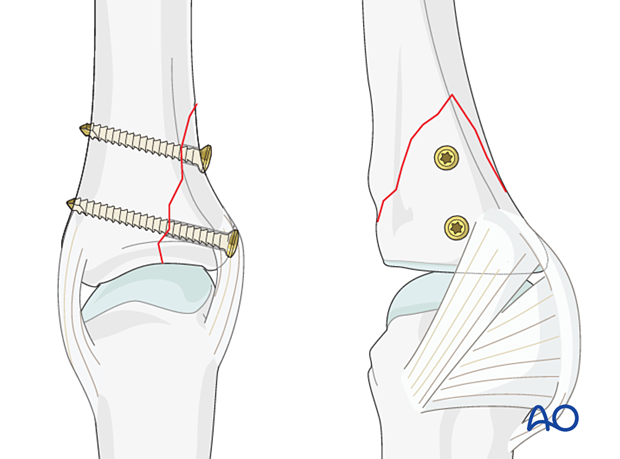 Fixation with two lag screw of a partial articular fracture of proximal phalanx – hand.