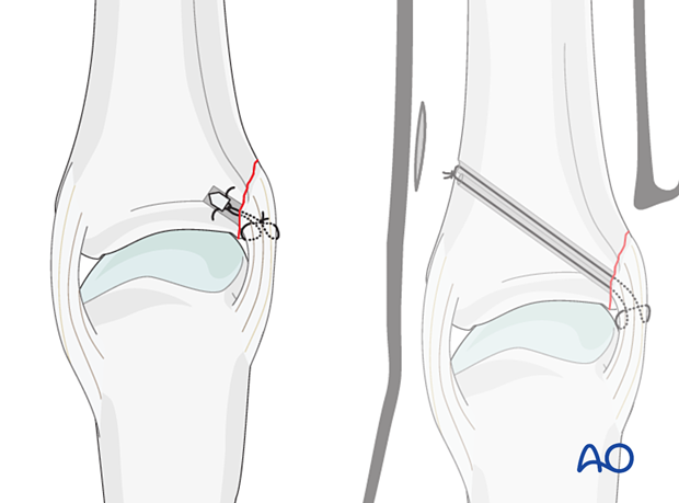 Suture anchor and bone tunneling techniques for collateral ligament reattachment of a proximal avulsion fracture of the metacarpophalangeal joint proximal – phalanx – hand.