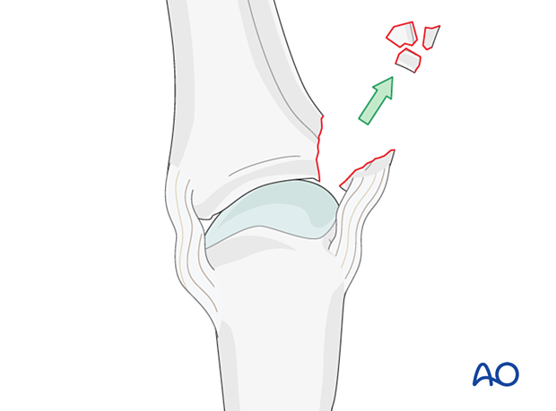 Small fragments removal – collateral ligament reattachment of a proximal avulsion fracture of the metacarpophalangeal joint proximal – phalanx – hand.