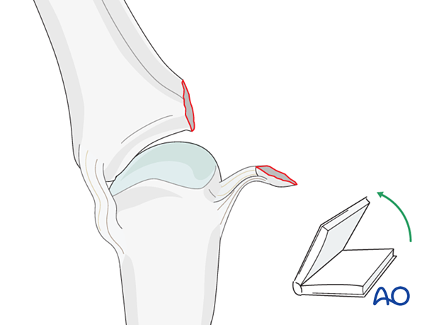 Phalanx laterally deviated to visualize joint – collateral ligament reattachment of a proximal avulsion fracture of the metacarpophalangeal joint proximal – phalanx – hand.