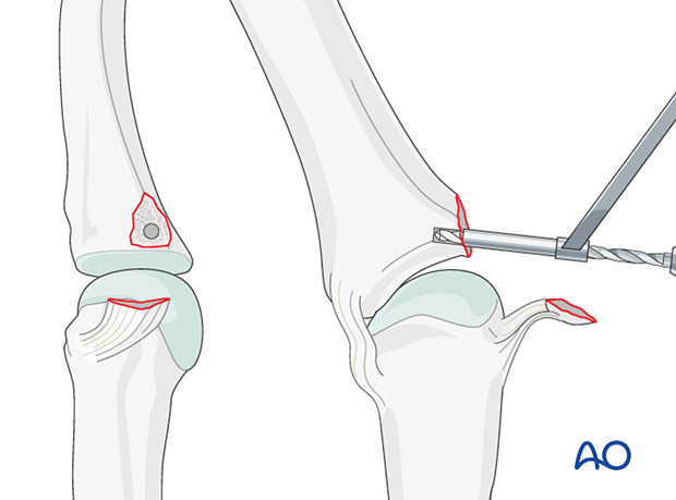 AP and lateral view of drilling the anchor hole – collateral ligament reattachment of a proximal avulsion fracture of the metacarpophalangeal joint proximal – phalanx – hand.