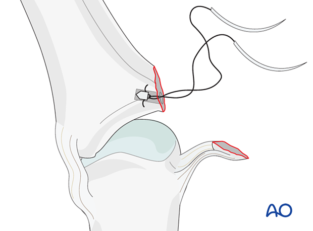 Anchor inserted in anchor hole – collateral ligament reattachment of a proximal avulsion fracture of the metacarpophalangeal joint proximal – phalanx – hand.