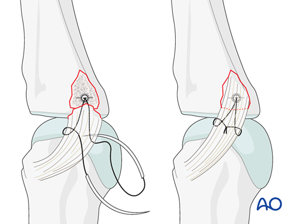 Ligament transfixed with anchor sutures – collateral ligament reattachment of a proximal avulsion fracture of the metacarpophalangeal joint proximal – phalanx – hand.