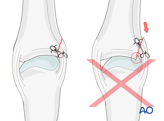 Correct, anatomic versus incorrect, nonanatomic placement anchor sutures – collateral ligament reattachment of a proximal avulsion fracture of the metacarpophalangeal joint proximal – phalanx – hand.