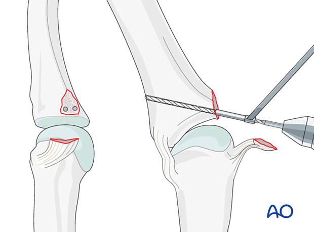 Drilling of parallel perforation holes – collateral ligament reattachment of a proximal avulsion fracture of the metacarpophalangeal joint proximal – phalanx – hand.