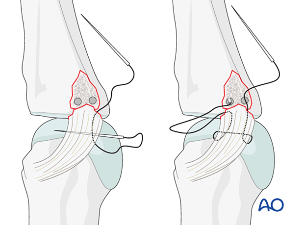 Suture insertion in perforation holes – collateral ligament reattachment of a proximal avulsion fracture of the metacarpophalangeal joint proximal – phalanx – hand.