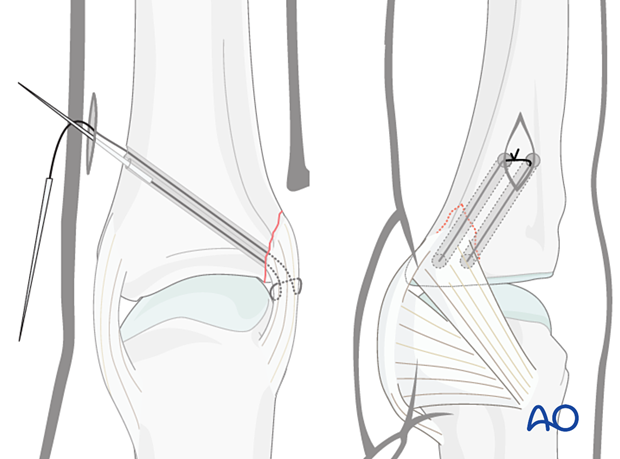 Suture retrieval and knotting – collateral ligament reattachment of a proximal avulsion fracture of the metacarpophalangeal joint proximal – phalanx – hand.