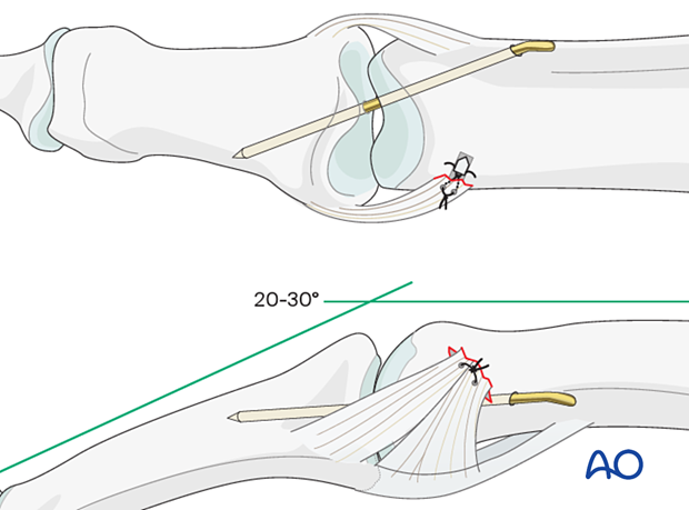 Collateral ligament repair with a suture anchor and K-wire transfixation at the distal end of the proximal phalanx