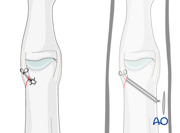 Collateral ligament repair at the distal end of the proximal phalanx with suture anchor and bone tunneling 