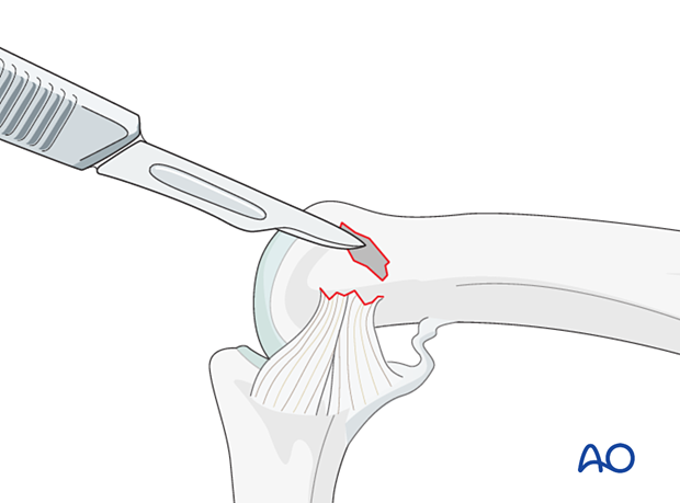 Collateral ligament repair with a suture anchor at the distal end of the proximal phalanx - Exposing the cancellous bone for reattachment