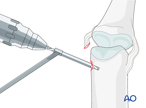 Collateral ligament repair with a suture anchor at the distal end of the proximal phalanx – drilling an anchor hole