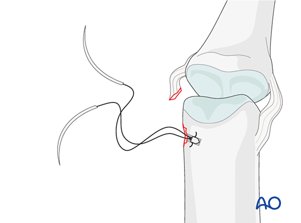 Collateral ligament repair with a suture anchor at the distal end of the proximal phalanx – Insertion of the anchor