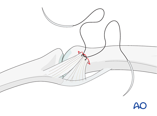 Collateral ligament repair with a suture anchor at the distal end of the proximal phalanx – Insertion of sutures