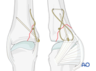 Compression cerclage wiring of an avulsion fracture at the base of a proximal phalanx