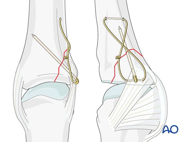 Cerclage compression wiring of a partial articular fracture of the proximal phalangeal base