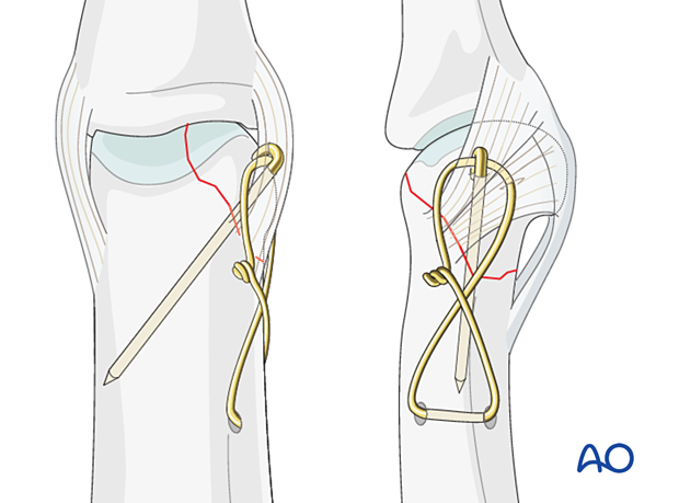 Cerclage compression wiring of a partial articular fracture of the proximal phalangeal head