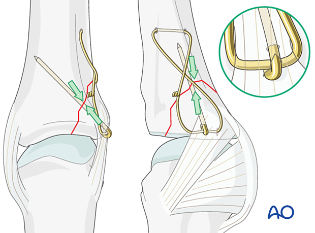 Cerclage compression wiring of a partial articular fracture of the proximal phalangeal base