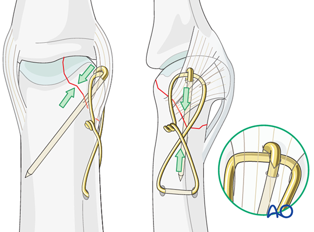 Cerclage compression wiring of a partial articular fracture of the proximal phalangeal head