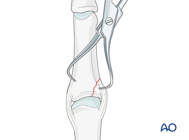 Reduction of a partial articular fracture of the proximal phalangeal base with forceps