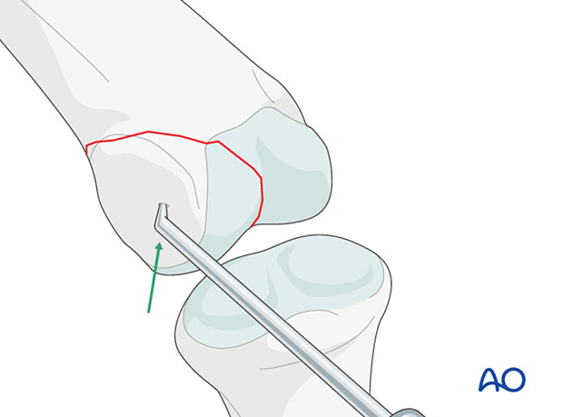 Reduction of a partial articular fracture of the proximal phalangeal head with a dental pick