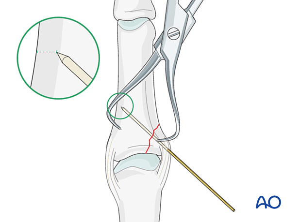 Cerclage compression wiring of a partial articular fracture of the proximal phalangeal base – K-wire insertion