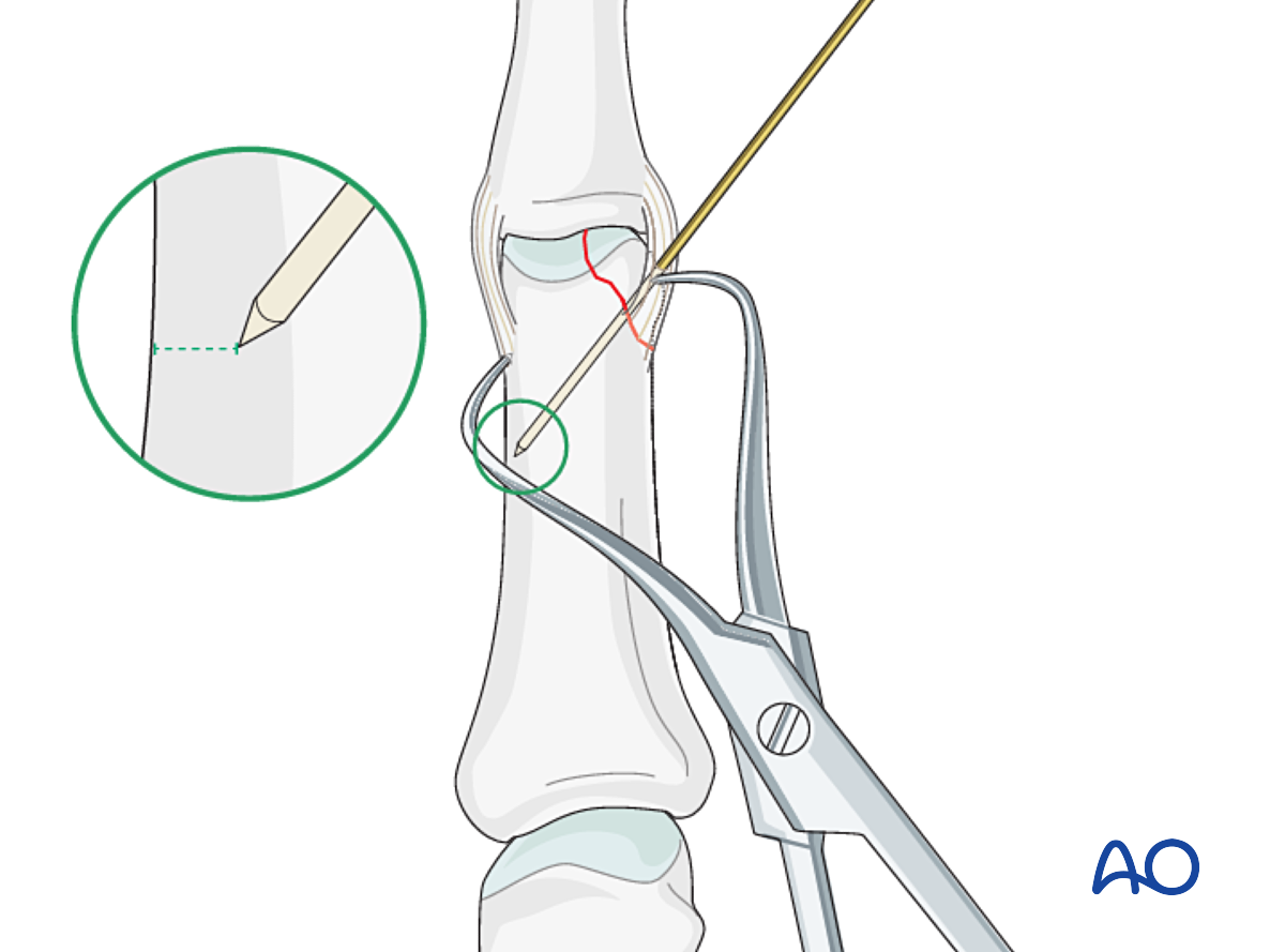 Cerclage Compression Wiring For Partial Articular Fracture Of The ...