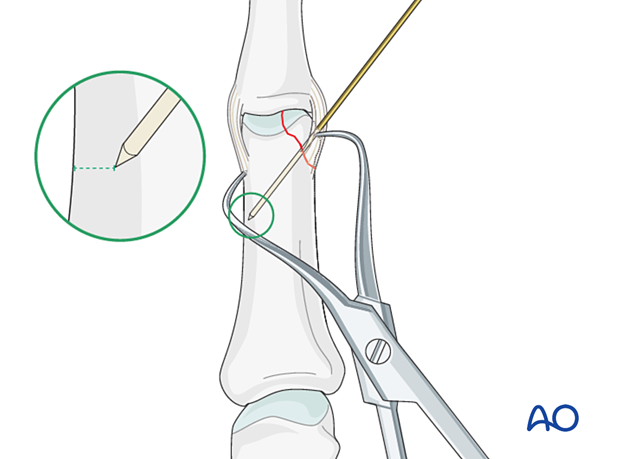 Cerclage compression wiring of a partial articular fracture of the proximal phalangeal head – K-wire insertion