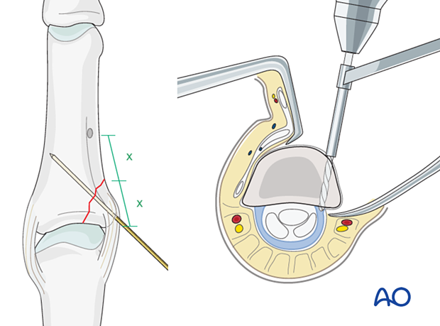 Cerclage compression wiring of a partial articular fracture of the proximal phalangeal base – Drilling a hole