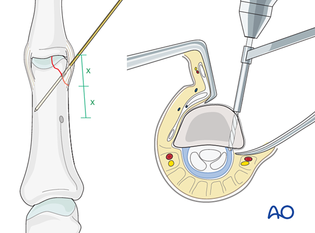 Cerclage compression wiring of a partial articular fracture of the proximal phalangeal head – Drilling a hole