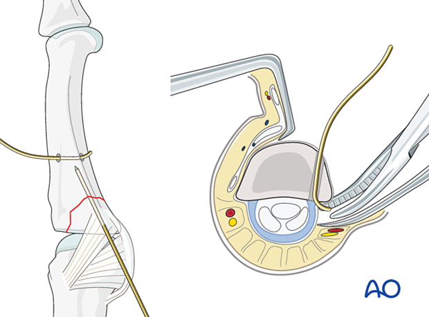 Cerclage compression wiring of a partial articular fracture of the proximal phalangeal base – wire application