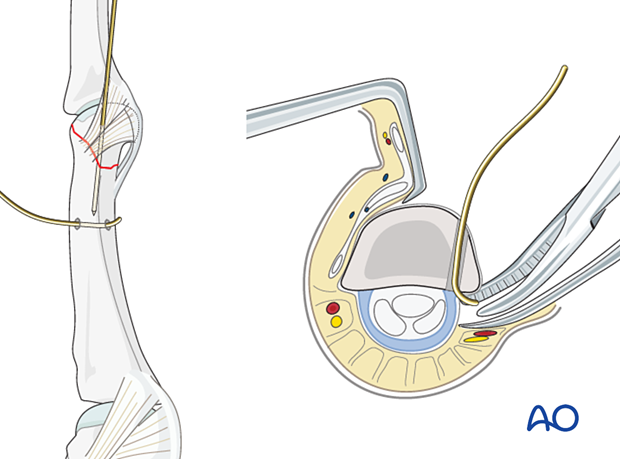 Cerclage compression wiring of a partial articular fracture of the proximal phalangeal head – wire application