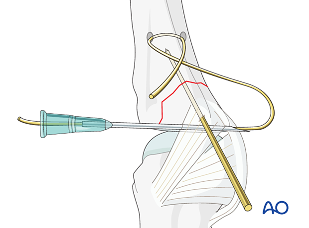 Cerclage compression wiring of a partial articular fracture of the proximal phalangeal base – wire application