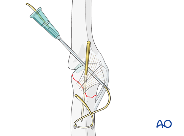 Cerclage compression wiring of a partial articular fracture of the proximal phalangeal head – wire application