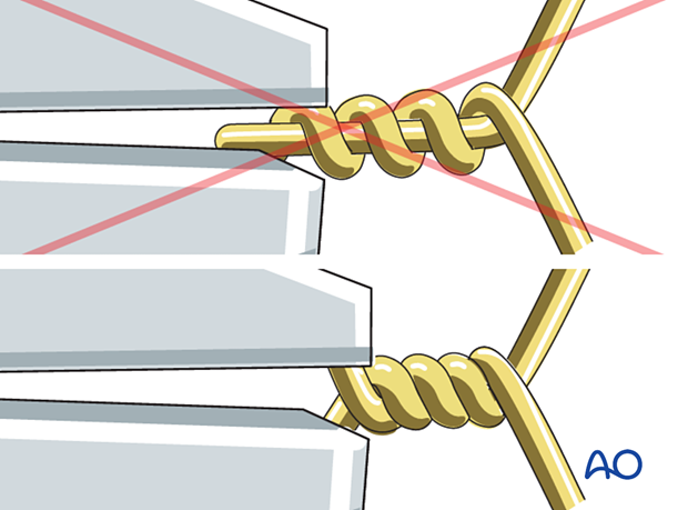 Cerclage compression wiring - Tightening the wire