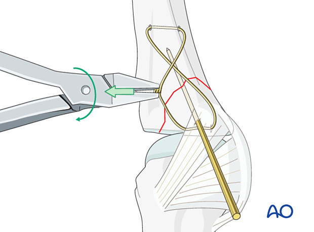 Cerclage compression wiring of a partial articular fracture of the proximal phalangeal base – Tightening the wire