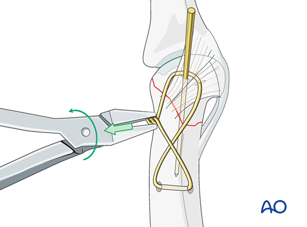 Cerclage compression wiring of a partial articular fracture of the proximal phalangeal head – Tightening the wire