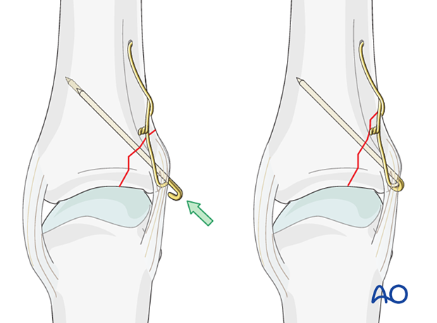 Cerclage compression wiring of a partial articular fracture of the proximal phalangeal base - anchoring the K-wire