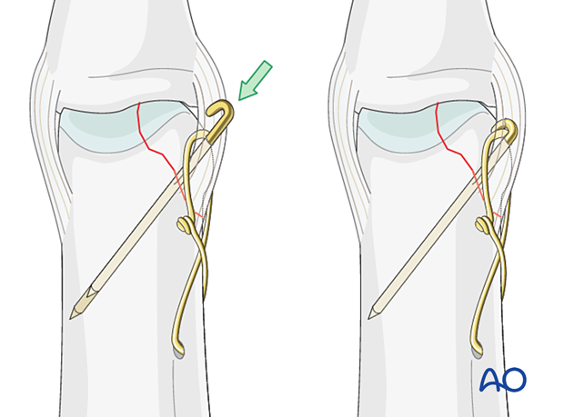 Cerclage compression wiring of a partial articular fracture of the proximal phalangeal head - anchoring the K-wire