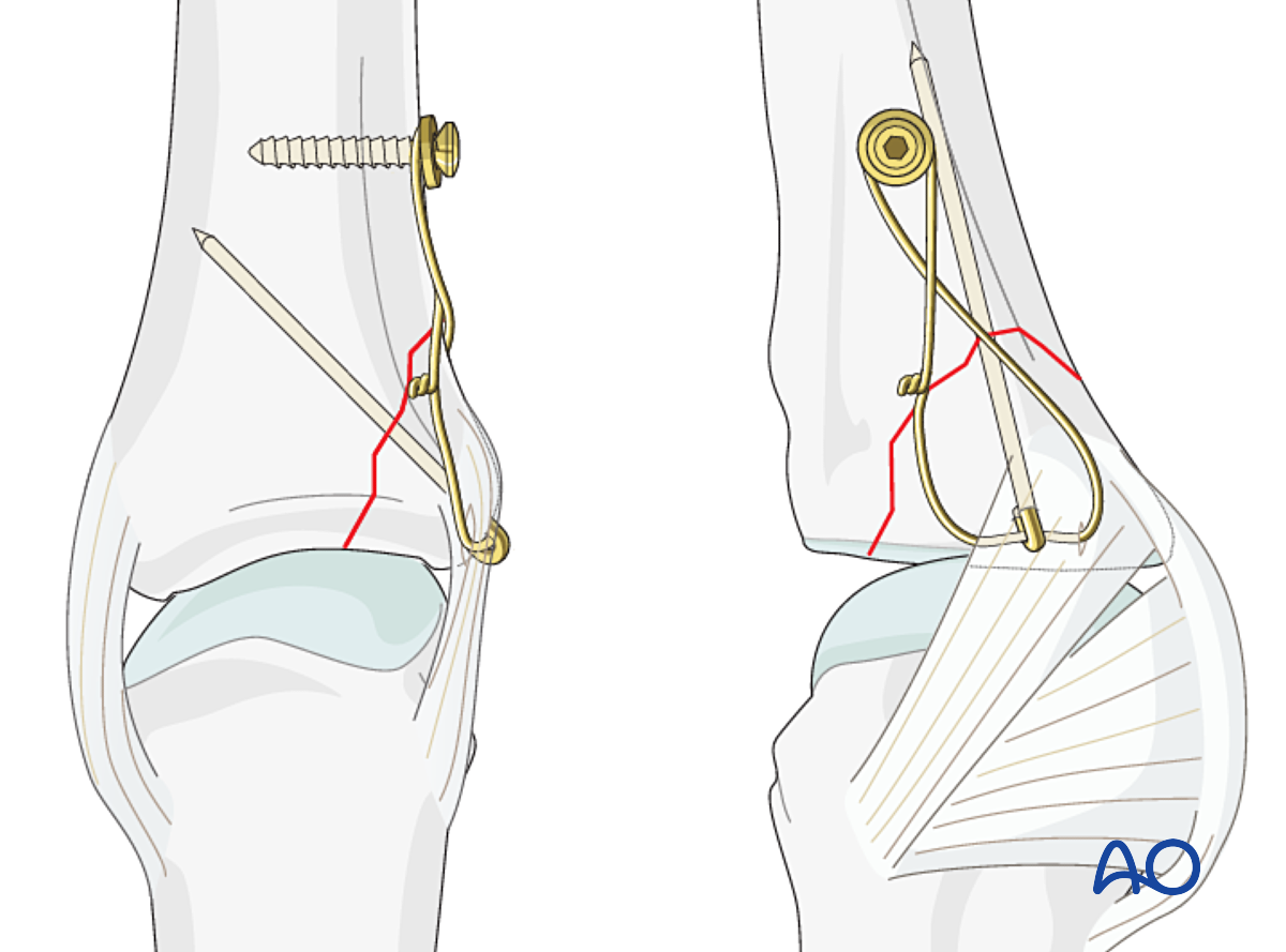 Cerclage Compression Wiring For Partial Articular Fracture Of The ...