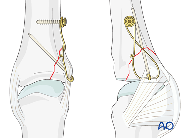 Cerclage compression wiring of a partial articular fracture of the proximal phalangeal base with an anchor screw