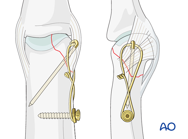 Cerclage compression wiring of a partial articular fracture of the proximal phalangeal head with an anchor screw