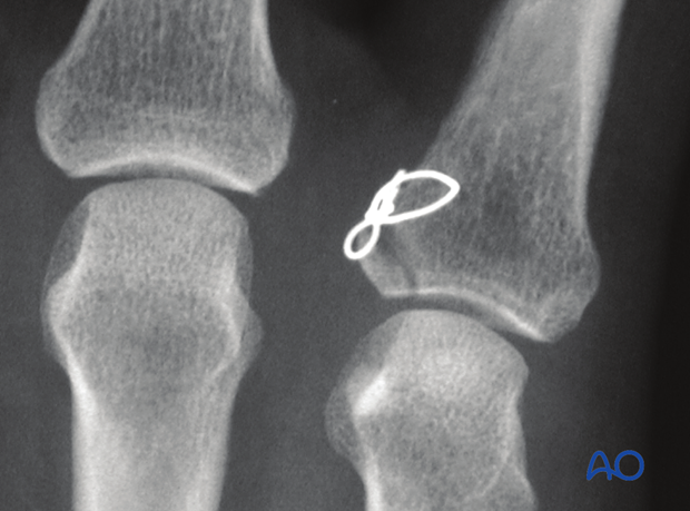 Fixation of an avulsion fracture of the proximal phalangeal base with a figure-of-eight cerclage