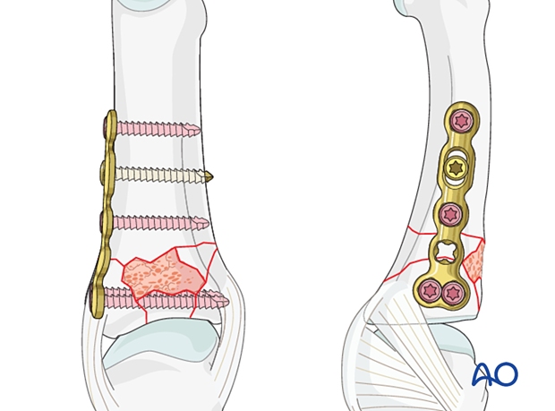 Plate fixation of a complete articular fracture of the proximal phalangeal base