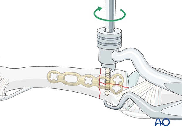 Fixation of a complete articular fracture of the proximal phalangeal base by inserion of a screw in the articular block