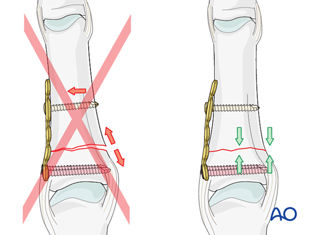 Compression plating of transverse fracture of the proximal phalangeal base