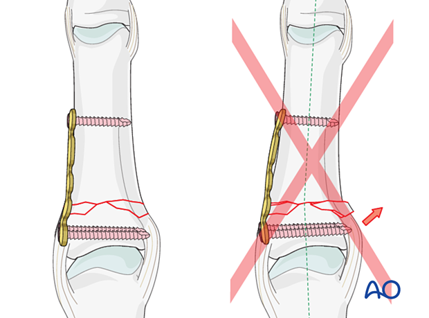 Bridge plating of a multifragmentary extraarticular fracture of the proximal phalangeal base